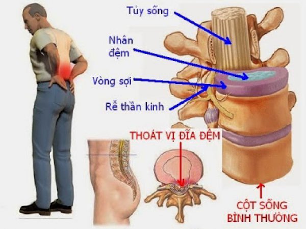 Thoát vị đĩa đệm có đạp xe được không? Lợi ích và lưu ý cần biết